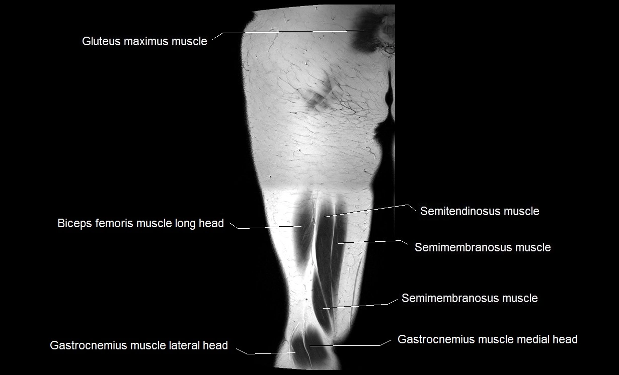 MRI thigh coronal cross sectional anatomy image 21.webp